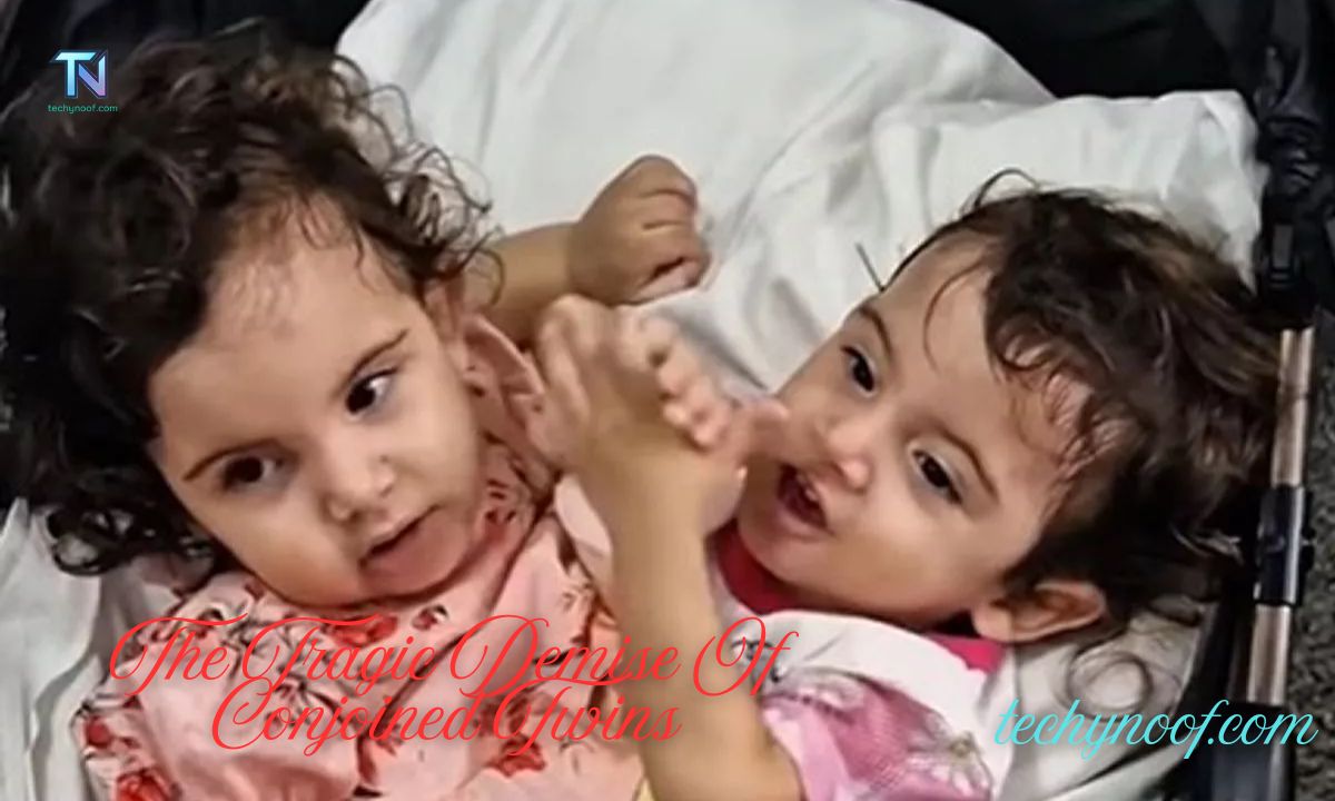 Understanding The Tragic Demise Of Conjoined Twins: The Cause Of Abby And Brittany Hensel's Death – Unraveling The Mystery